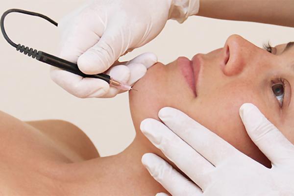 Electrolysis Hair Removal